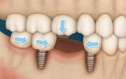 Movimiento dental por ausencia de pieza consecuencias y solución con implante unitario