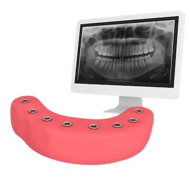 Diagnóstico de prótesis completa fija con radiografía o TAC
