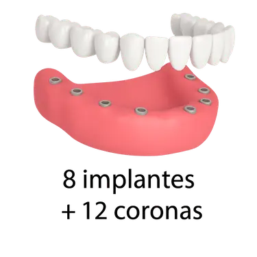 Representación 3D de una prótesis dental fija completa sobre 8 implantes y 12 coronas