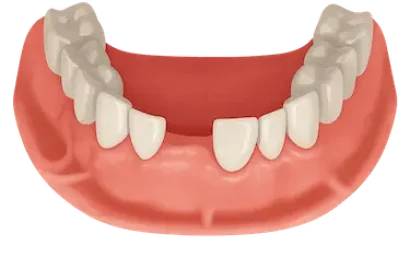 Tratamiento de implante dental unitario en Murcia para recuperar un diente perdido