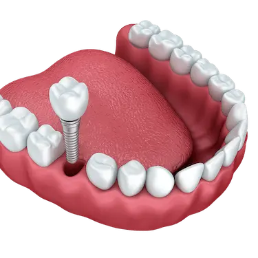 Implante dental con corona en la arcada inferior en Murcia realizado por el Dr. Ferrer