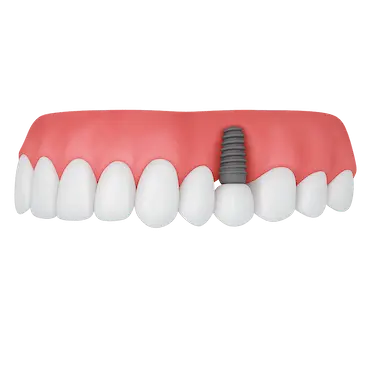 Vista frontal de encía con implante dental integrado y diente definitivo en la arcada superior