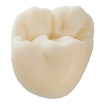 Corona de disilicato de litio sobre implante con alta translucidez y color natural