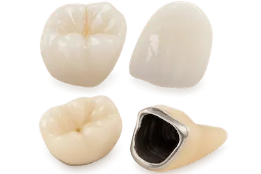 Comparativa visual de coronas sobre implante dental de disilicato de litio y metal porcelana