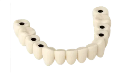 Prótesis dental fija completa atornillada sobre implantes en la clínica del Dr. Ferrer en Murcia