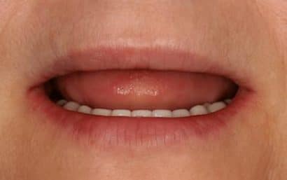 Boca de paciente con edentulismo en arcada superior sin dientes en el maxilar superior