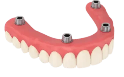Sobredentadura completa sobre cuatro implantes en la clínica dental del Dr. Ferrer en Murcia