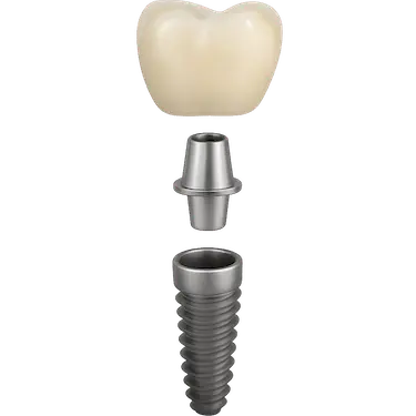 Estructura de una corona cementada sobre implante dental con pilar y tornillo de titanio