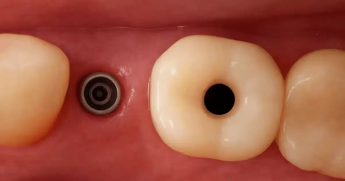 Corona dental sobre implante en Madrid con representación 3D tipo CAD CAM