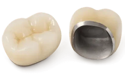 Corona dental sobre implante con base metálica y recubrimiento cerámico en clínica dental de Murcia