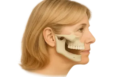 pérdida ósea en mandíbula inferior antes de prótesis removible con implantes en Murcia