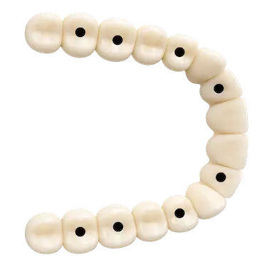 Prótesis dental fija completa inferior sobre ocho implantes en la clínica del Dr. Ferrer en Murcia