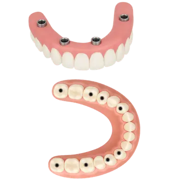 Prótesis dentales completas con implantes superiores e inferiores en Murcia
