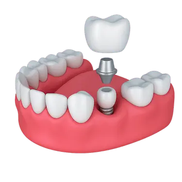 Corona dental sobre implante con tornillo, pilar y corona definitiva en arcada inferior