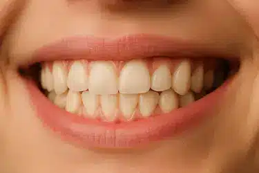Sonrisa con apiñamiento dental leve y dientes ligeramente desalineados