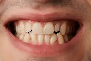 Dientes torcidos por falta de espacio, ejemplo de apiñamiento dental moderado