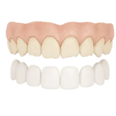 Carillas dentales para corregir dientes levemente desalineados y mejorar la estética dental