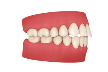 Mordida desalineada con mal encaje dental que provoca desgaste y fracturas en los dientes