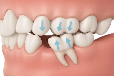 Vista 3D del desplazamiento de dientes vecinos tras la pérdida de una pieza dental