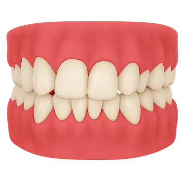 Modelo dental 3D con dientes torcidos y apiñamiento leve en ambas arcadas