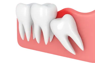 Muela del juicio inclinada presionando el diente vecino y causando apiñamiento dental