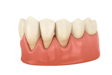 Encía con periodontitis avanzada mostrando pérdida ósea, retracción y dientes desplazados