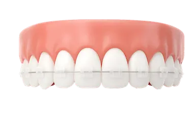 Brackets estéticos en modelo dental para corregir una sonrisa desalineada de forma discreta