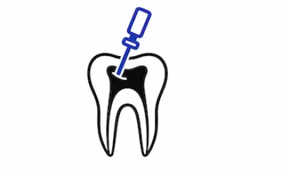 Tarifas de endodoncia en la clínica dental del Dr. Ferrer