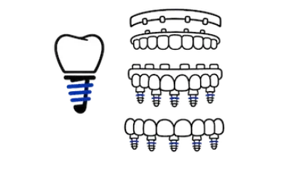 Tarifas de prótesis completas con implantes en la clínica dental del Dr. Ferrer
