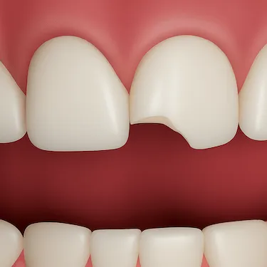 Primer plano de diente frontal roto que requiere reparación urgente en clínica dental en Madrid