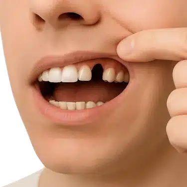 Pérdida de un diente que requiere atención urgente en clínica dental de Madrid