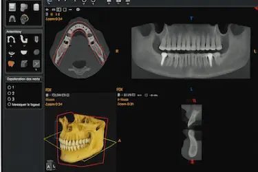 Pantalla de ordenador con imágenes 3D y radiografías dentales en clínica dental de Murcia