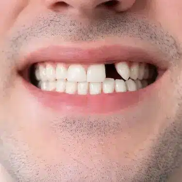 Paciente con diente ausente en la sonrisa, atendido en clínica dental en Murcia