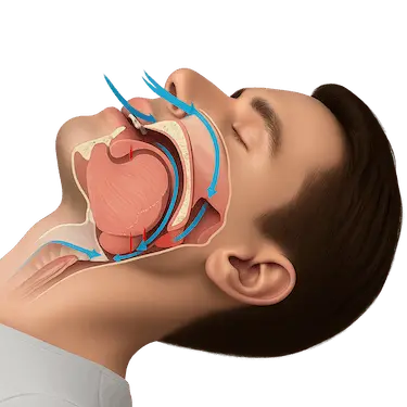 Esquema de vía aérea mostrando cómo se producen los ronquidos al dormir