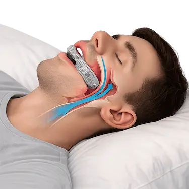 Hombre durmiendo con férula de avance mandibular para tratar ronquidos y apnea del sueño