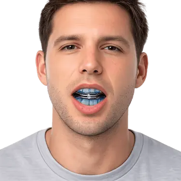 Paciente con dispositivo de avance mandibular OrthoApnea Classic para tratar ronquidos y apnea del sueño