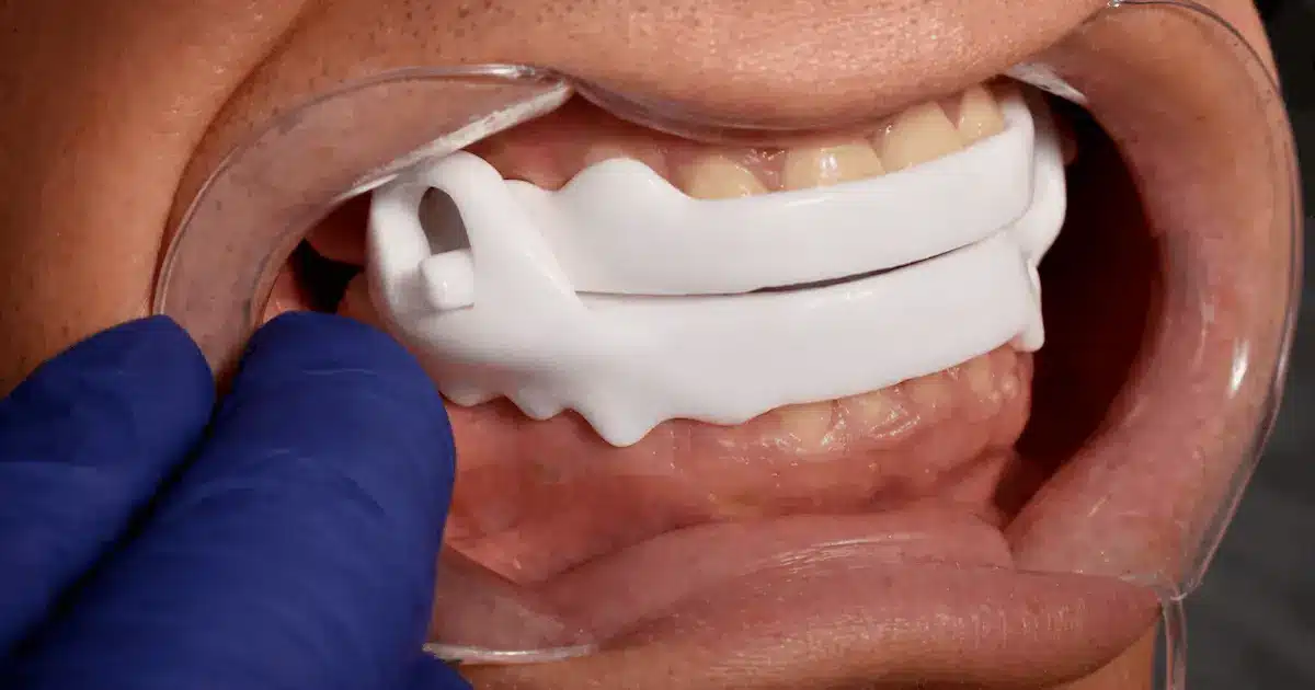 Férula antirronquidos de avance mandibular colocada por dentista en Madrid