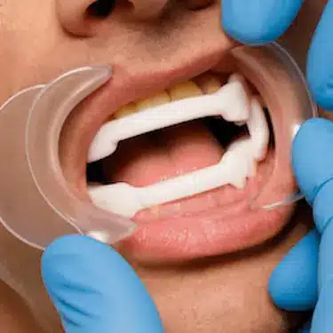Prueba férula antirronquidos o dispositivo de avance mandibular para tratar apnea del sueño