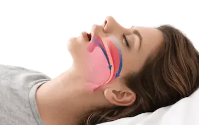 Tratamiento de apnea del sueño con dispositivo de avance mandibular que mejora la respiración durante el sueño