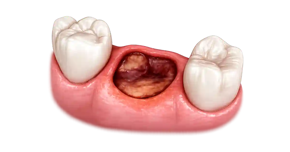 Alveolitis dental con alvéolo sin coágulo y hueso expuesto tras extracción