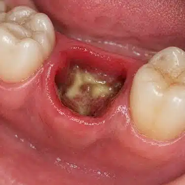 Alveolitis húmeda con pus en el alvéolo e inflamación tras extracción