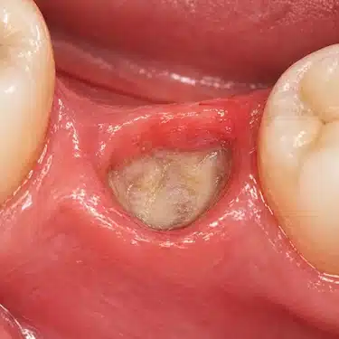 Alveolitis seca con alvéolo sin coágulo y aspecto blanquecino tras extracción