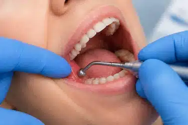 Drenaje de encía inflamada en muela del juicio para tratar pericoronaritis