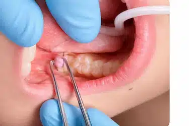 Retirada de encía sobre muela del juicio para tratar pericoronaritis