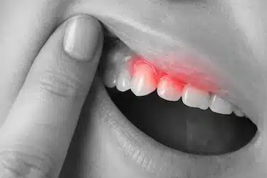 Encía enrojecida e inflamada alrededor de muela del juicio por pericoronaritis