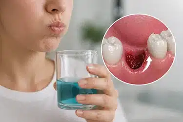 Enjuague fuerte tras extracción dental que puede desalojar el coágulo y causar alveolitis
