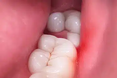 Muela del juicio parcialmente erupcionada con encía que favorece infección