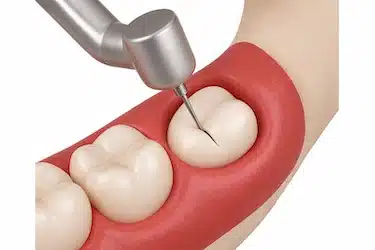Extracción de muela del juicio para resolver pericoronaritis recurrente