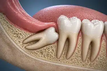 Muela del juicio retenida asociada a extracción dental compleja y riesgo de alveolitis