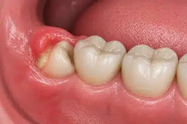 Infección previa en encía antes de extracción dental que aumenta riesgo de alveolitis